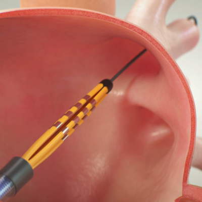 Ontdek het FARAPULSE PFA-systeem en hoe het werkt.