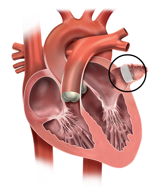 Leer meer over LAAC met Watchman FLX.
