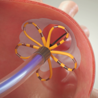 Ontdek het FARAPULSE PFA-systeem en hoe het werkt.
