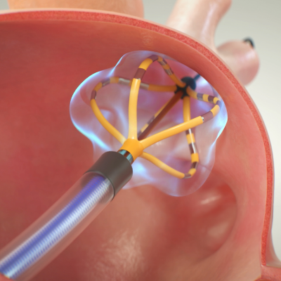 Ontdek het FARAPULSE PFA-systeem en hoe het werkt.